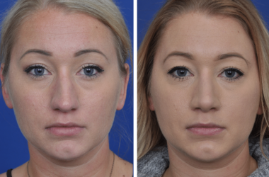 Septoplasty and Rhinoplasty