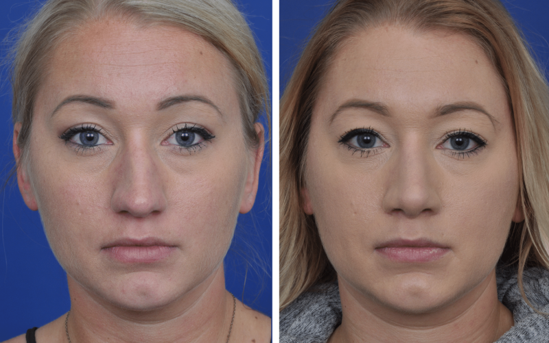 Septoplasty and Rhinoplasty